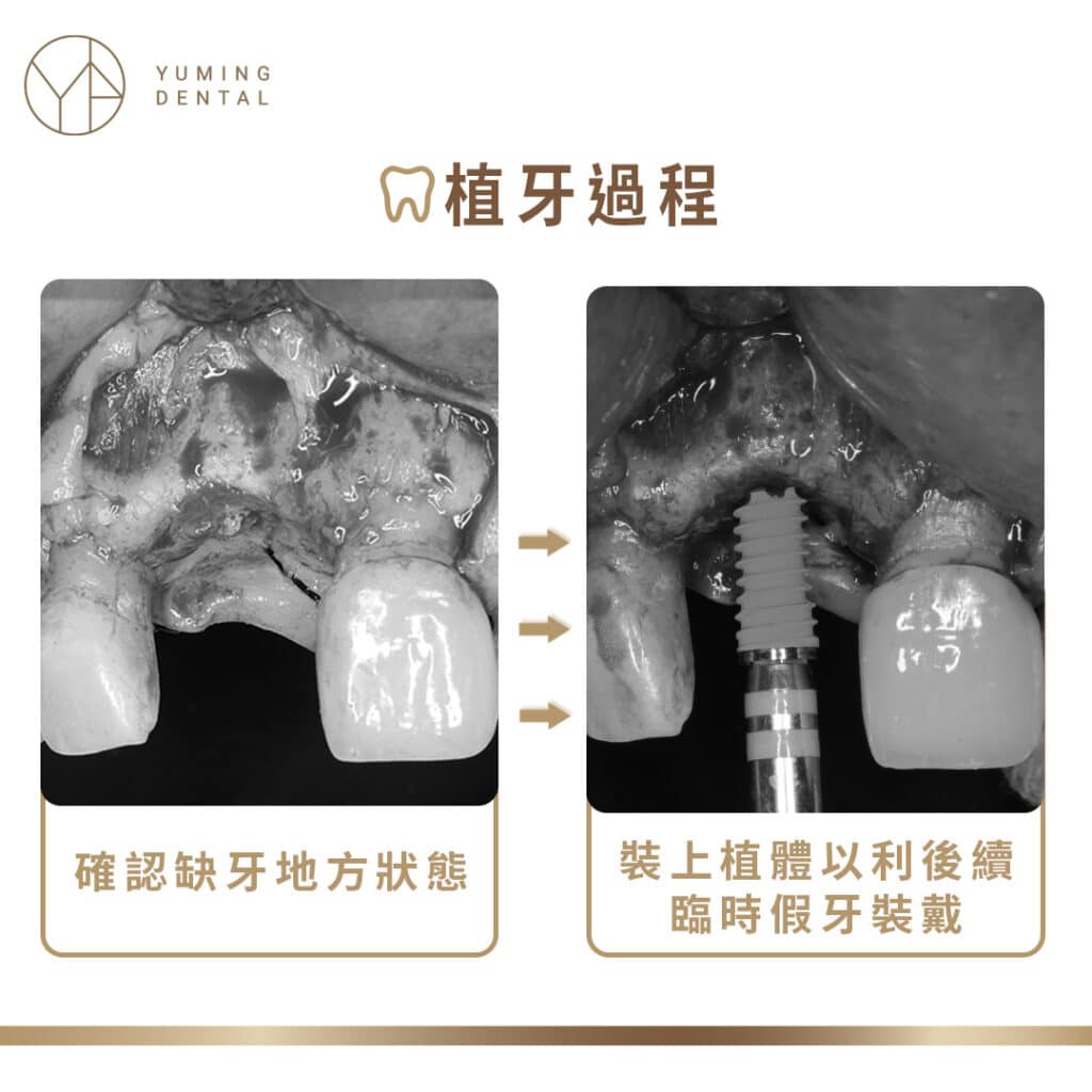 植牙過程―放入植體以利後續臨時假牙裝戴