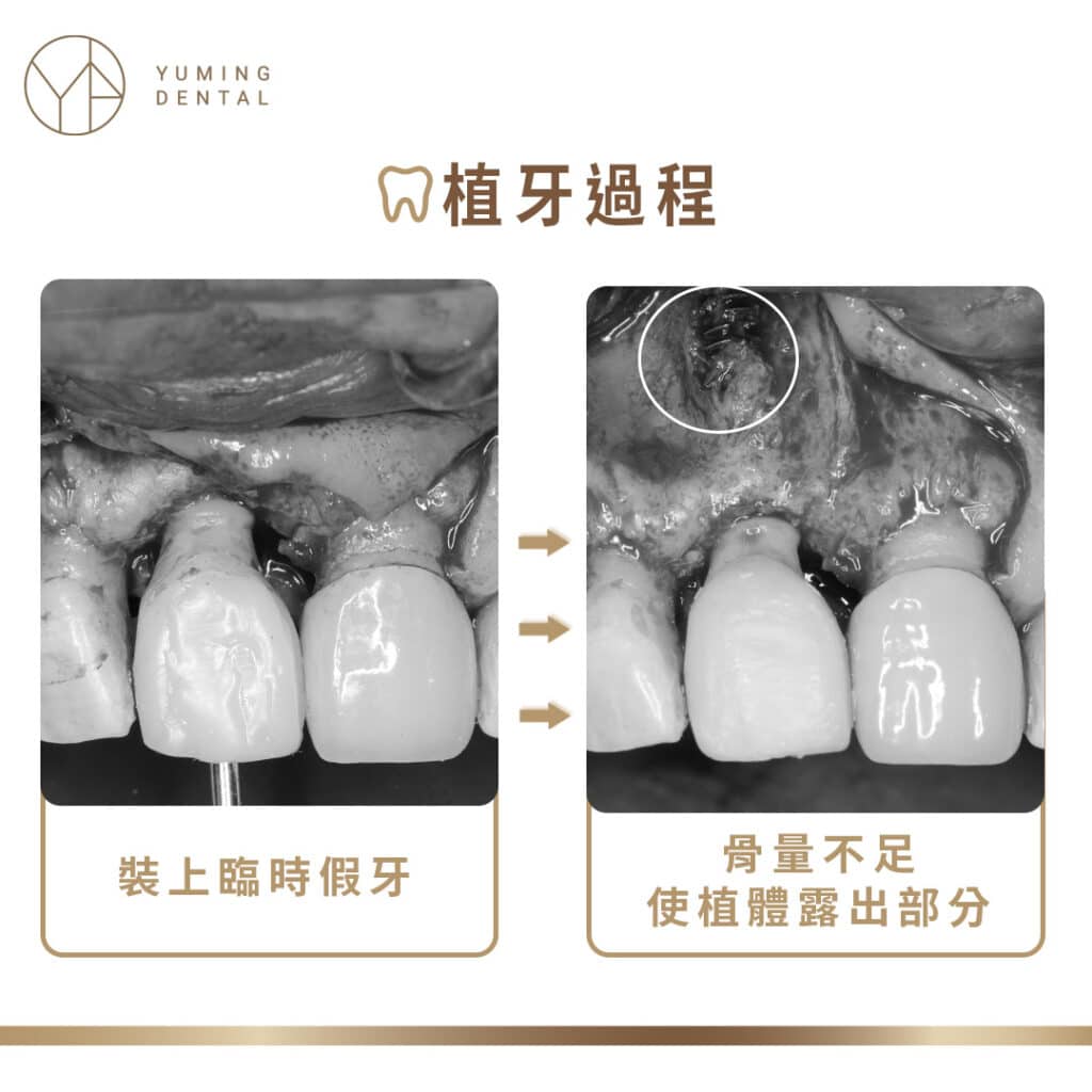 植牙過程―裝上臨時假牙，骨量不足植體外露