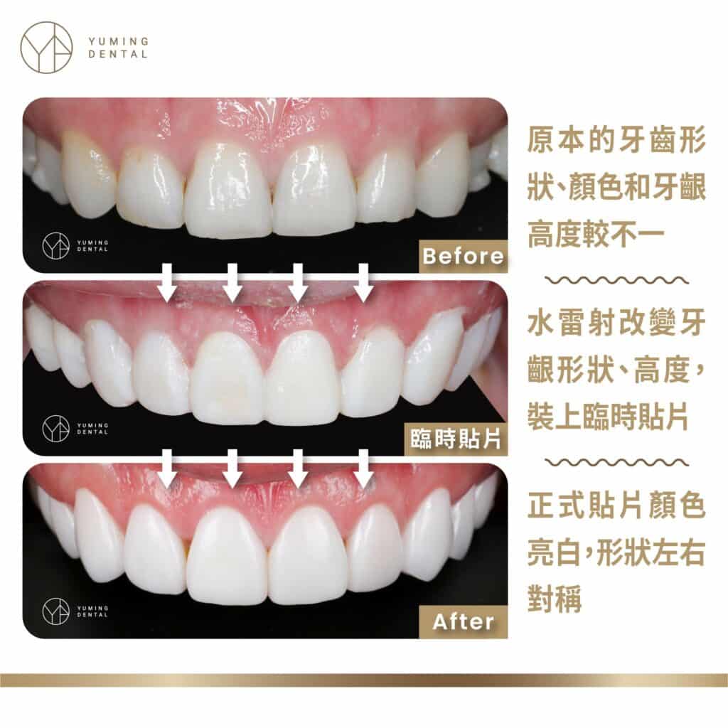 原本牙齒形狀、顏色和牙齦高度較不一，水雷射改變牙齦形狀、高度