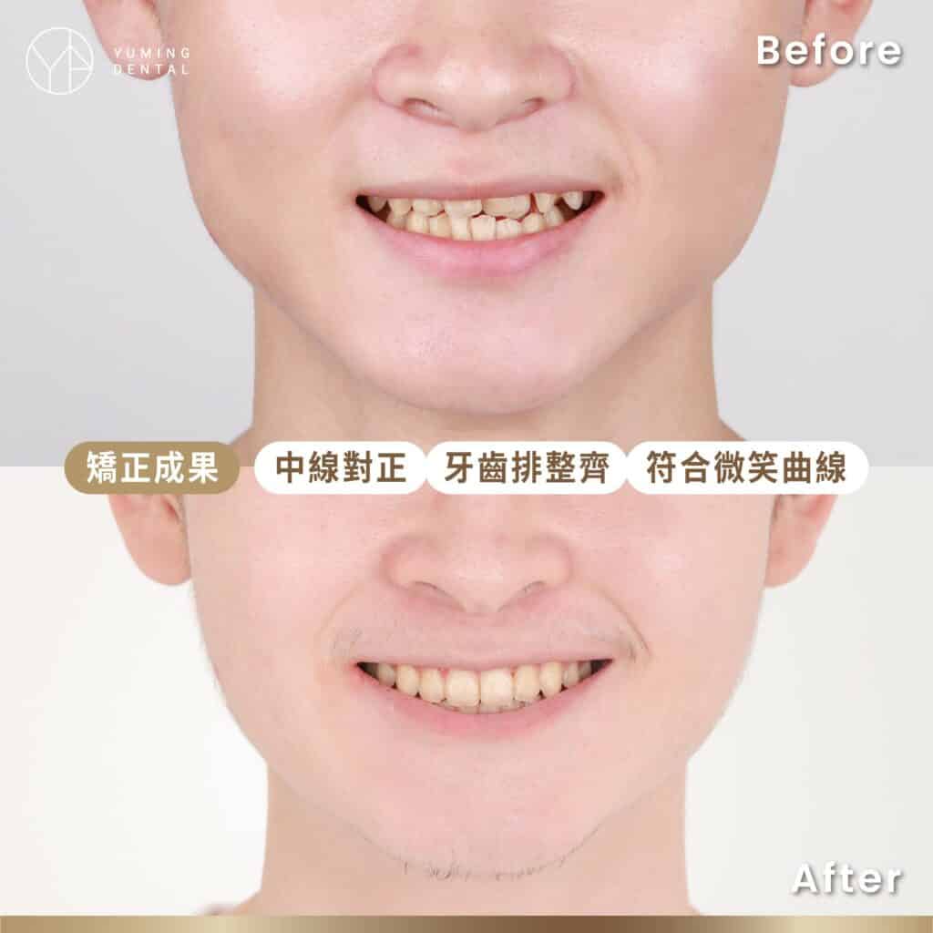 矯正成果：中線對正、牙齒排整齊、符合微笑曲線