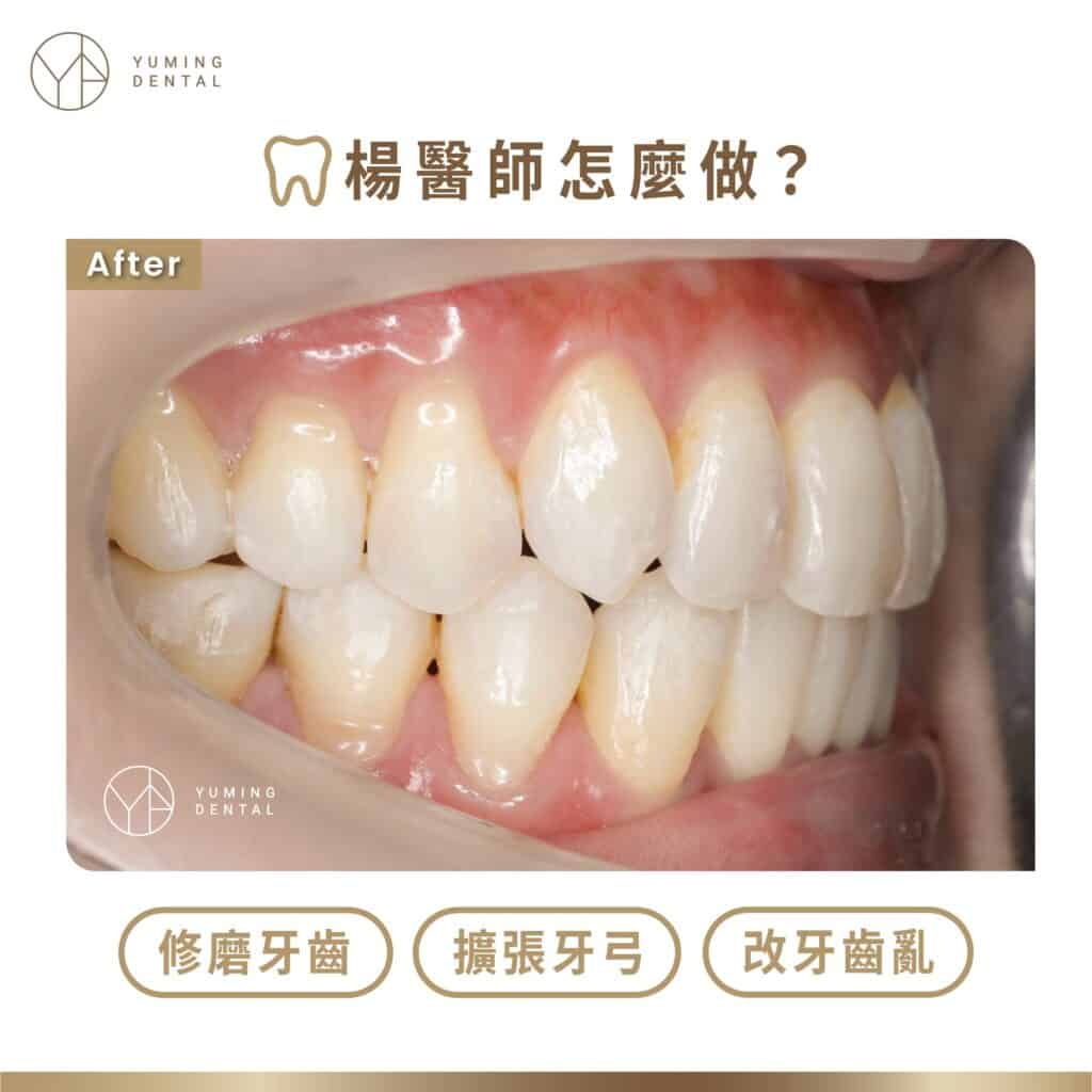 楊醫師怎麼做：修磨牙齒 擴張牙弓 改牙齒亂