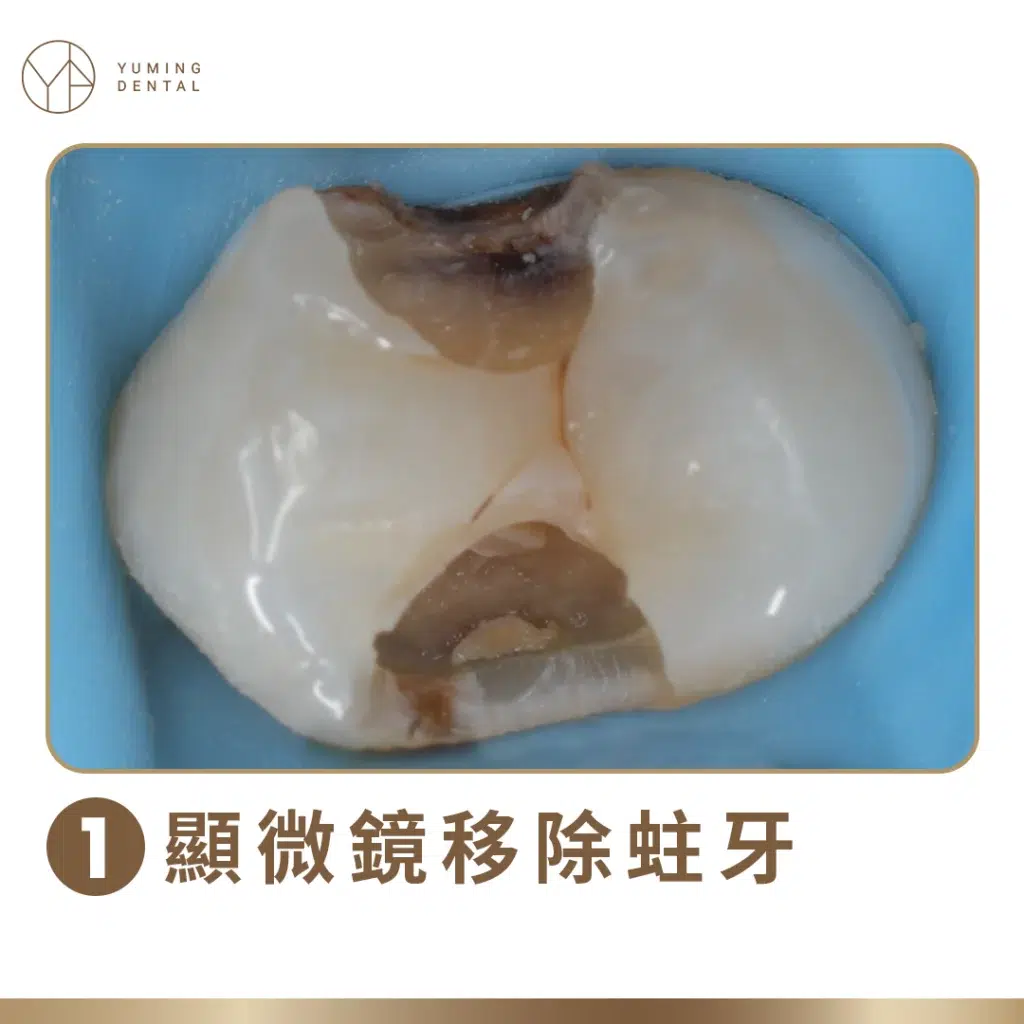 活髓治療－牙科顯微鏡移除蛀牙