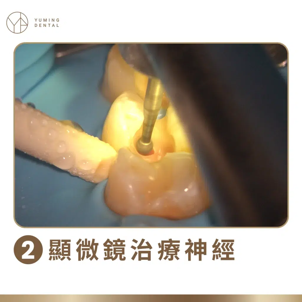 活髓治療－牙科顯微鏡治療神經