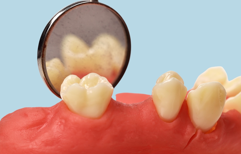  牙周病 症狀依據嚴重程度分成 4 階段
