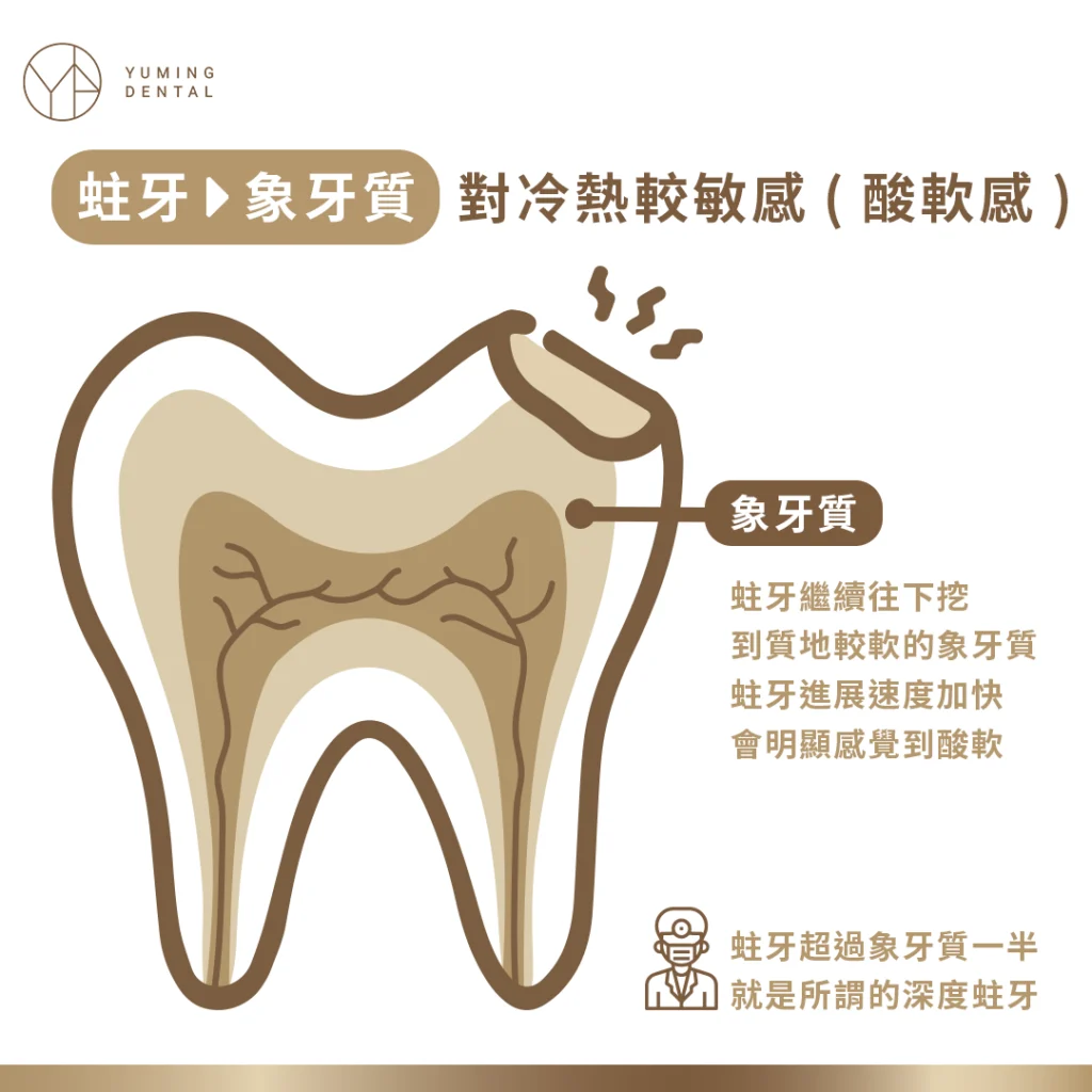 蛀牙階段-象牙質