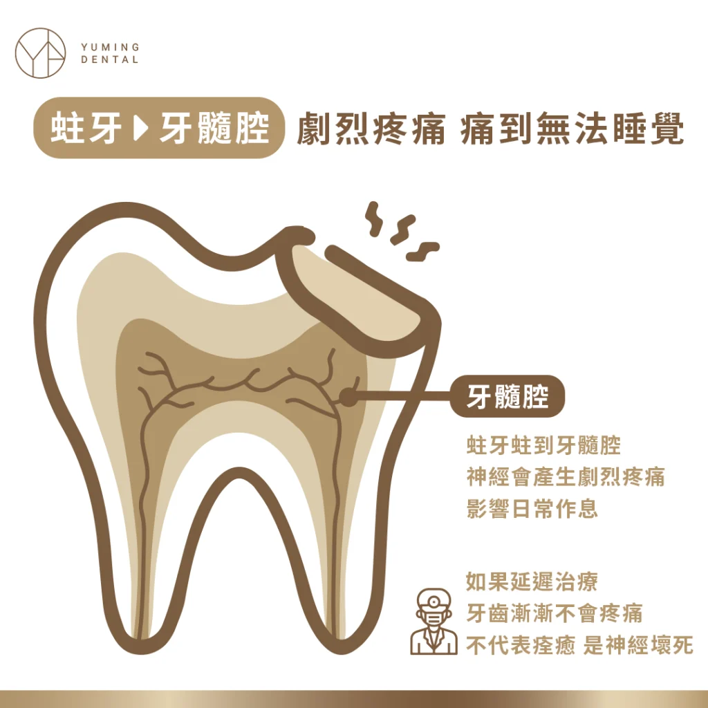 蛀牙階段-牙髓腔