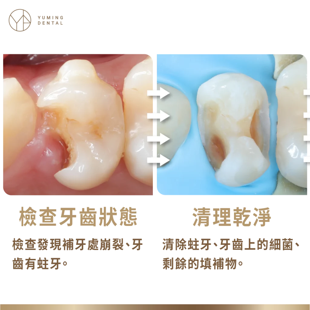 美學補牙療程：檢查牙齒與清理蛀牙
