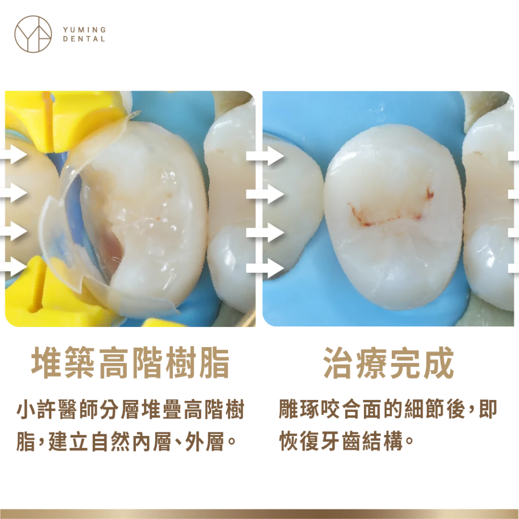 美學補牙療程：補上高階樹脂加上修磨就完成