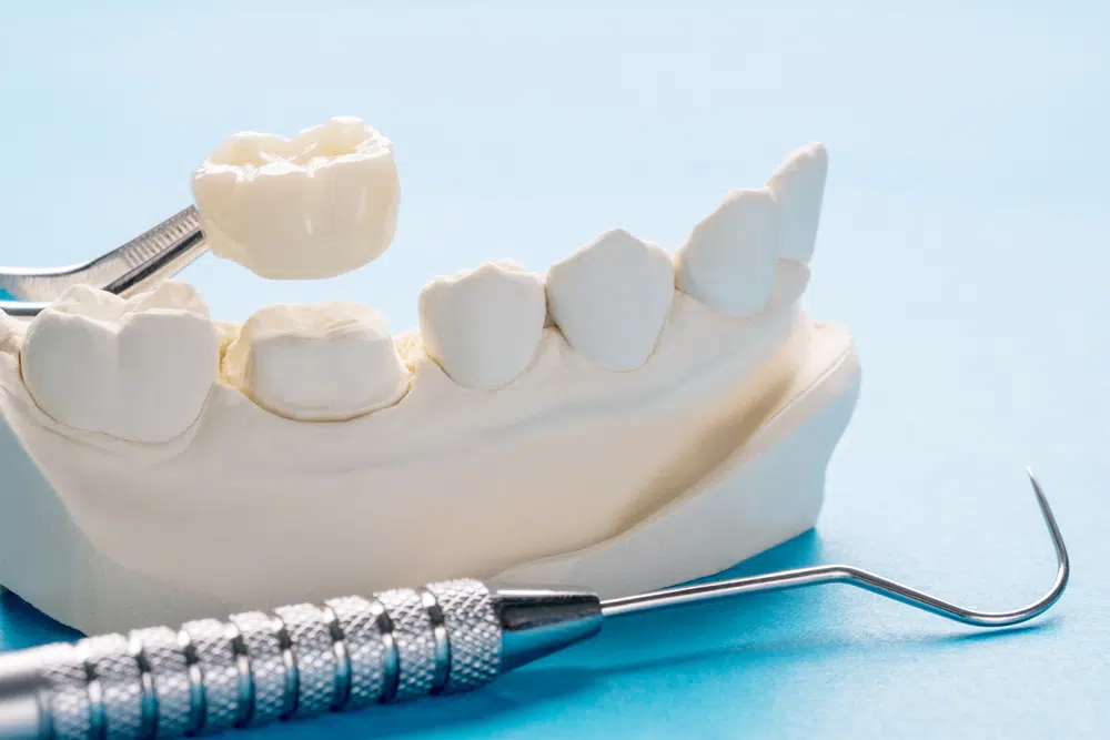 牙齒根管治療（抽神經）牙套費用是多少？牙冠材質不同費用也會有所差異