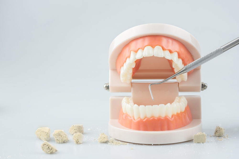 4個減少牙結石生成的方法 