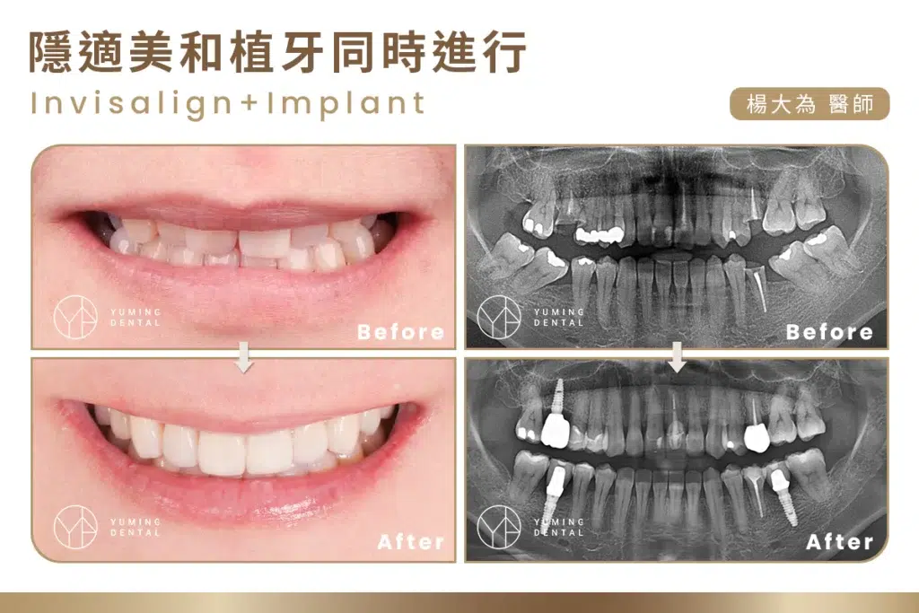 植牙搭配隱適美同時進行
