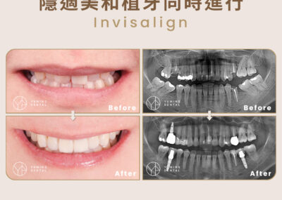 植牙也能搭配隱適美嗎？讓楊醫師帶你快速了解如何搭配