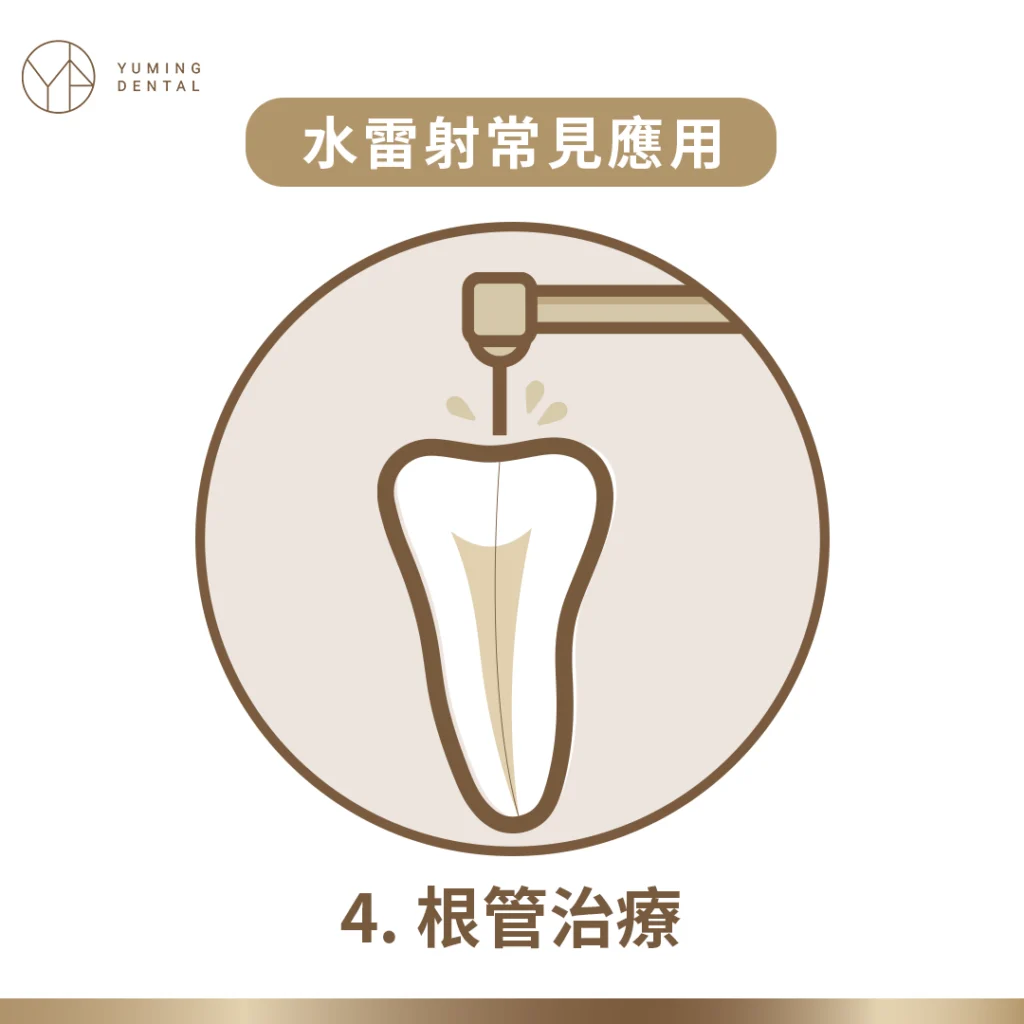 水雷射根管治療