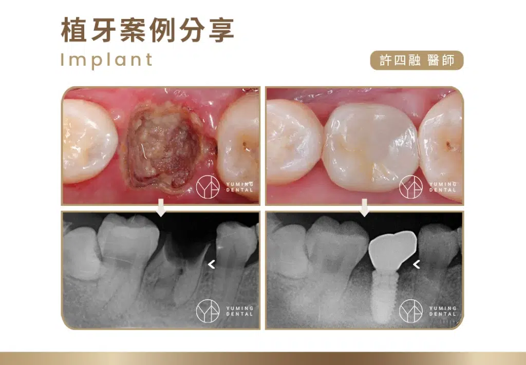 植牙案例分享｜臼齒斷裂－祐民牙醫 許四融醫師BPR case