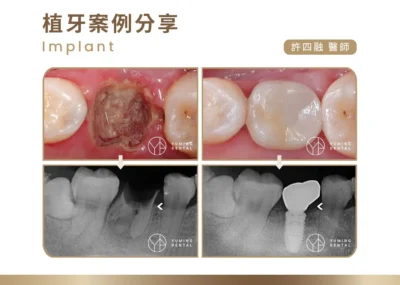 植牙案例分享