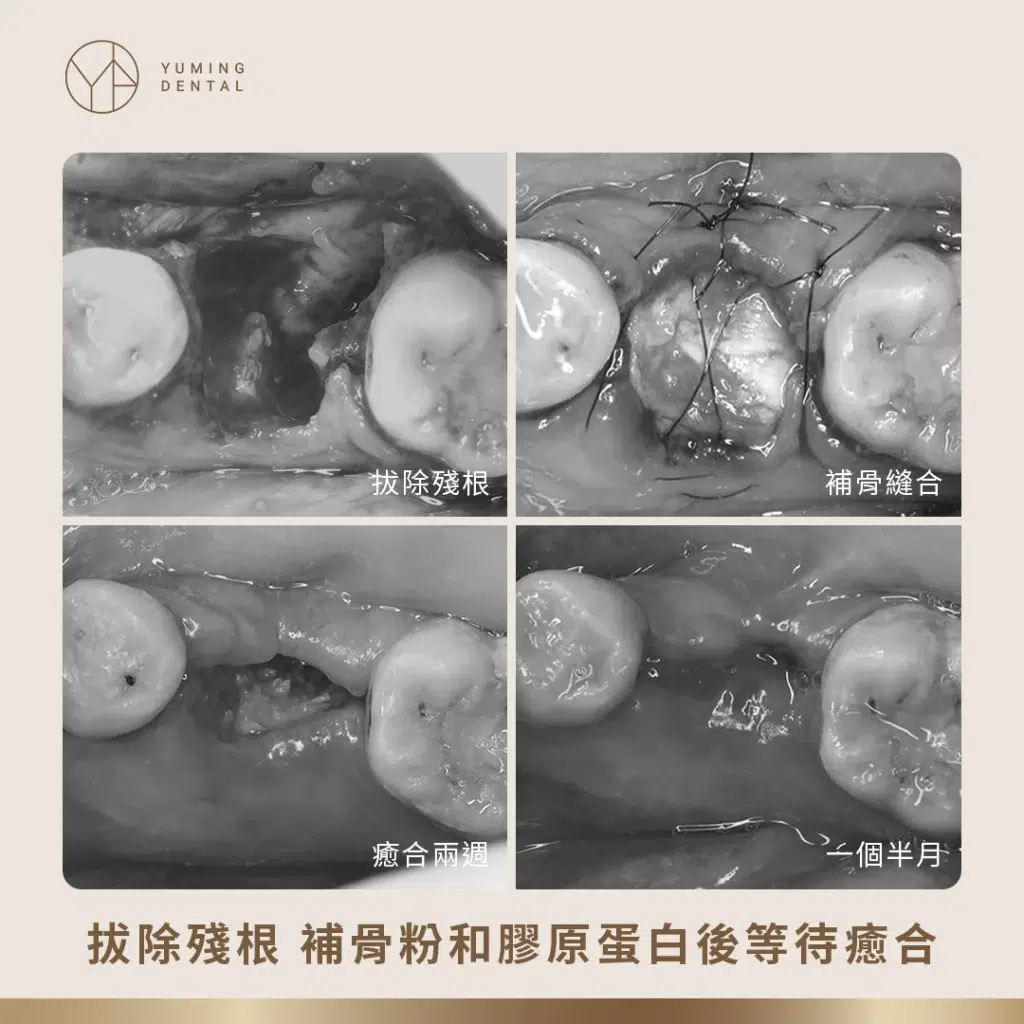 拔除牙齒殘根、補骨並等待傷口癒合