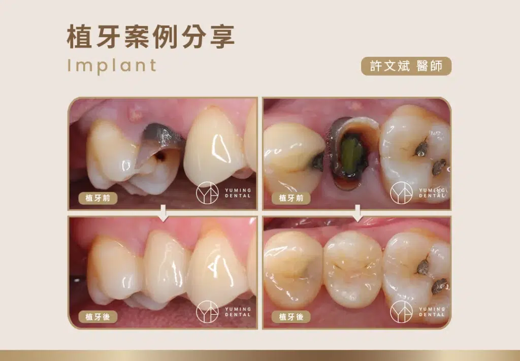 植牙案例分享｜嚴重蛀牙－祐民牙醫 許文斌醫師 Implant case