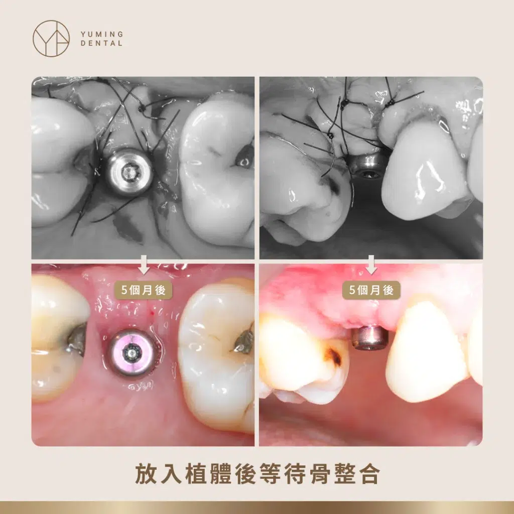 放入植體等待骨整合