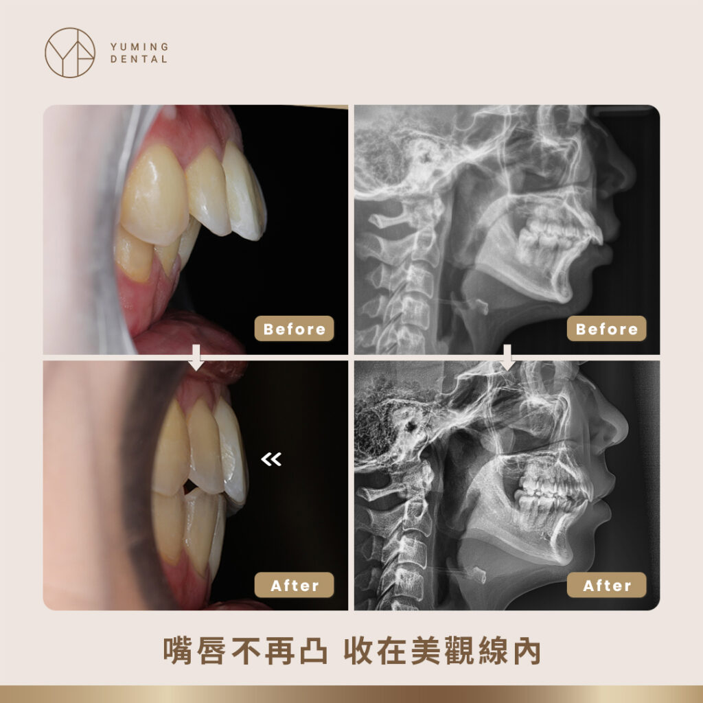 嘴唇順利收在美觀線後