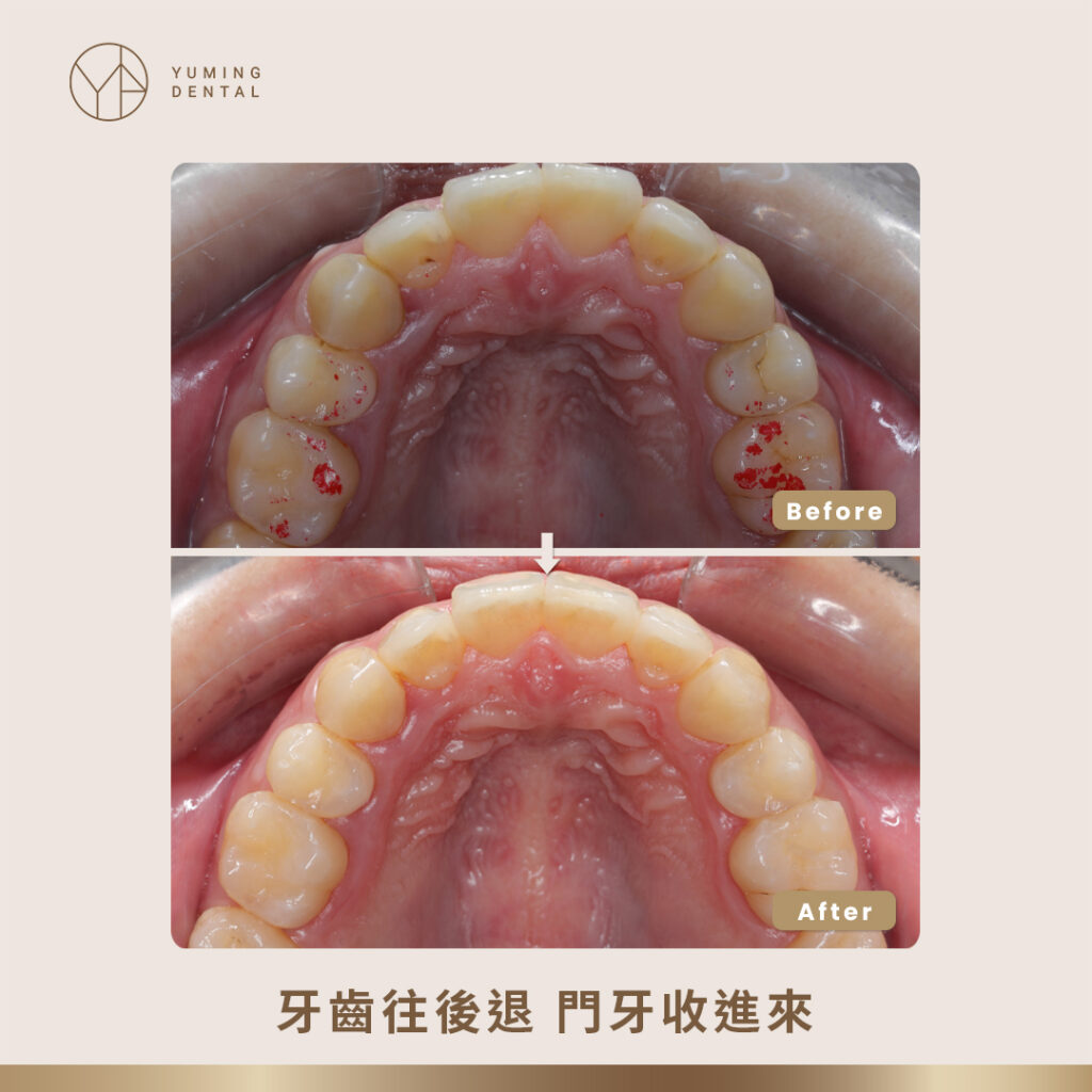 牙齒往後收進來