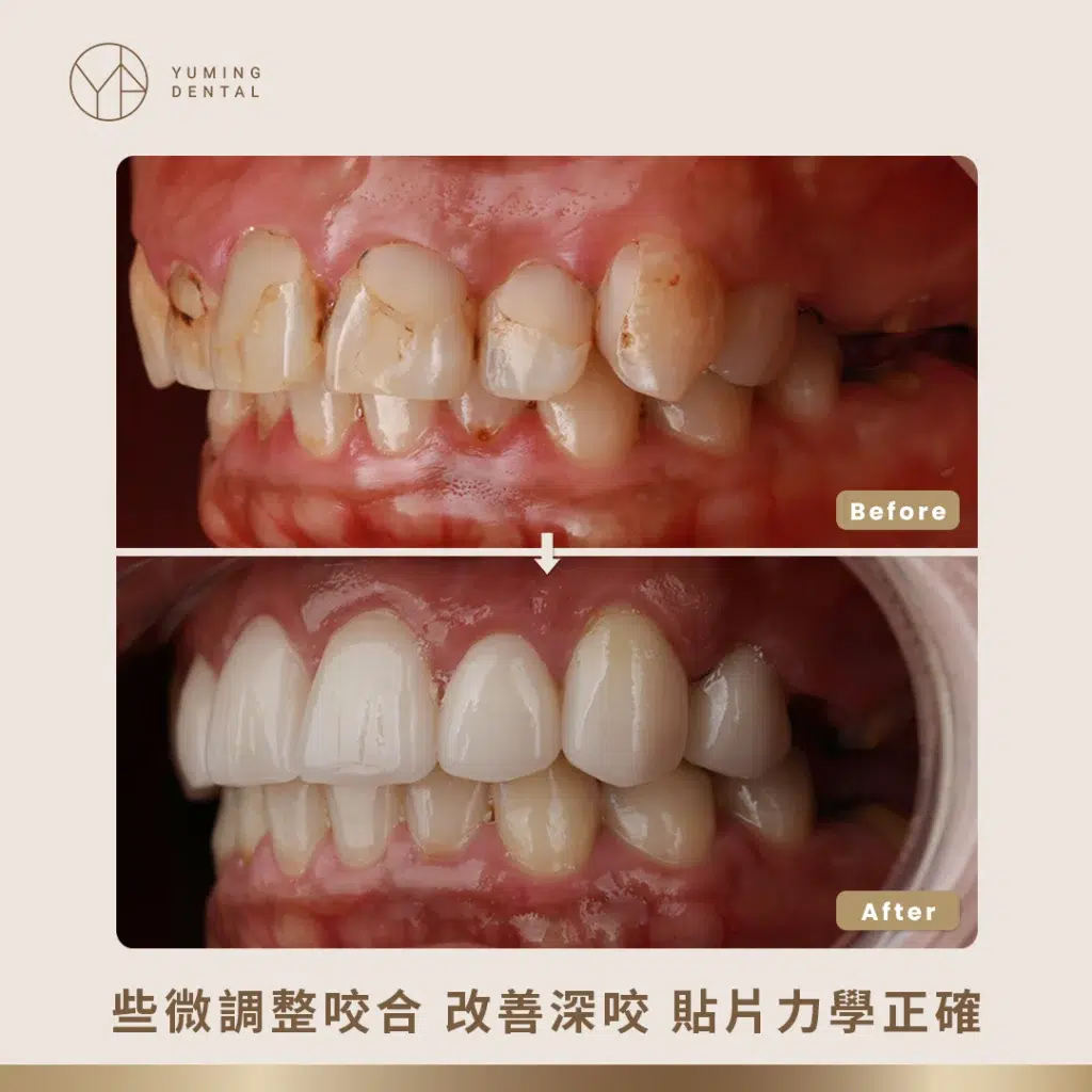 利用隱適美調整深咬