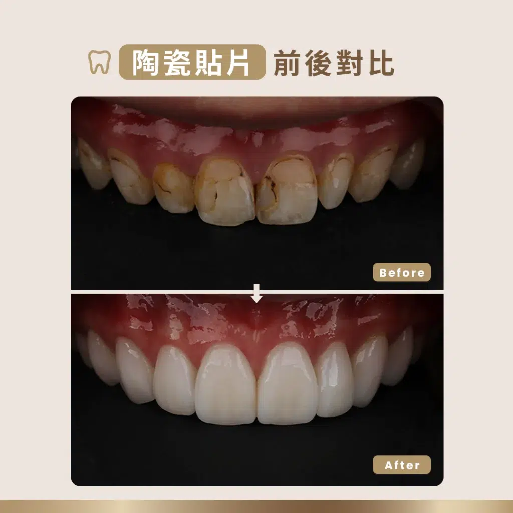 蛀牙製作陶瓷貼片前後對比