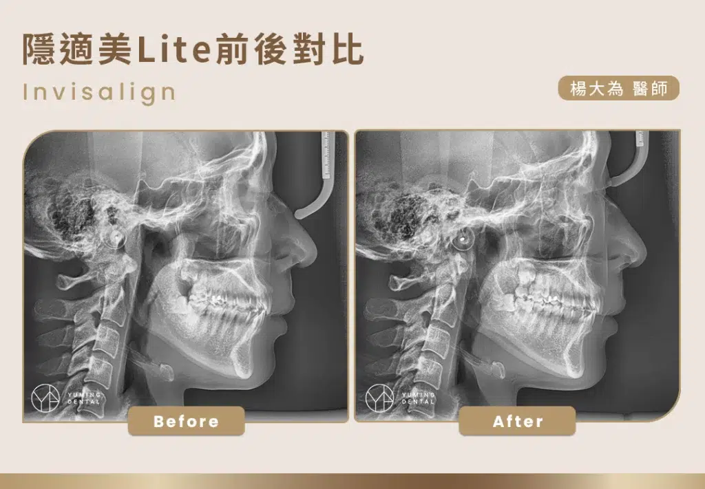 隱適美Lite矯正前後X光比對照