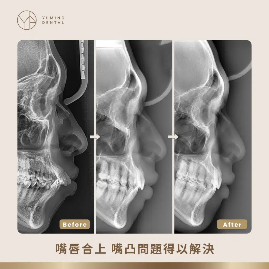 將凸出的牙齒收進來，改善嘴凸的問題