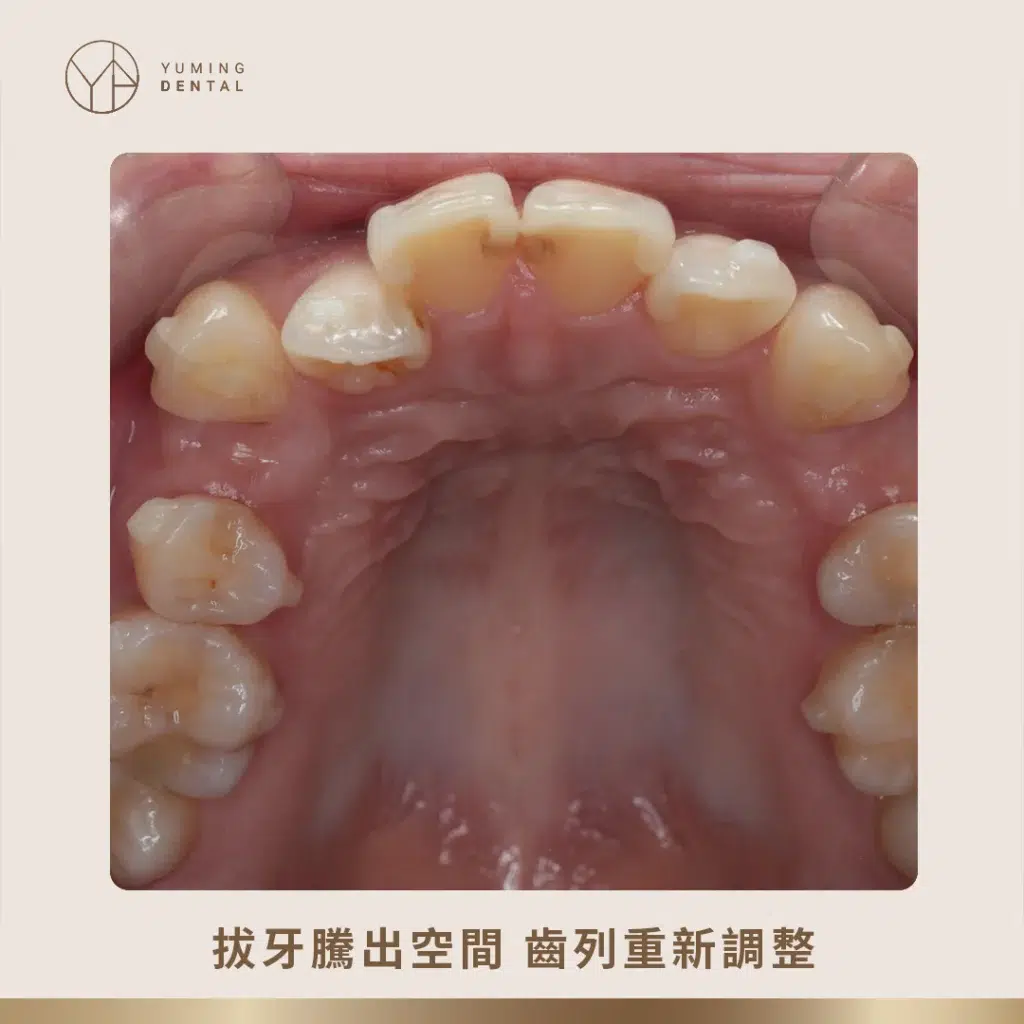 利用拔牙矯正騰出多餘空間