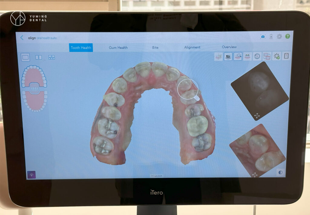 隱適美初步諮詢及資料蒐集