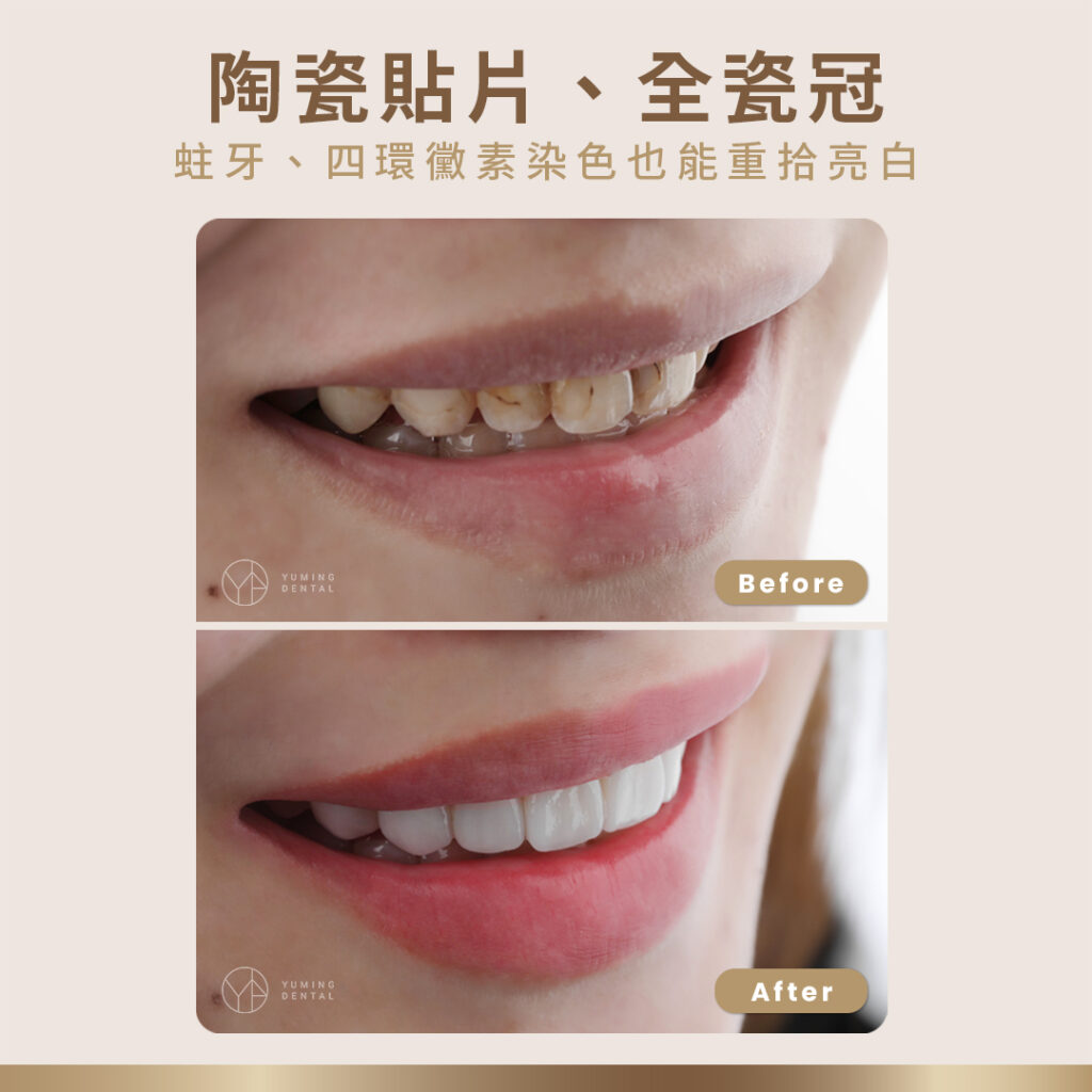 陶瓷貼片與全瓷冠