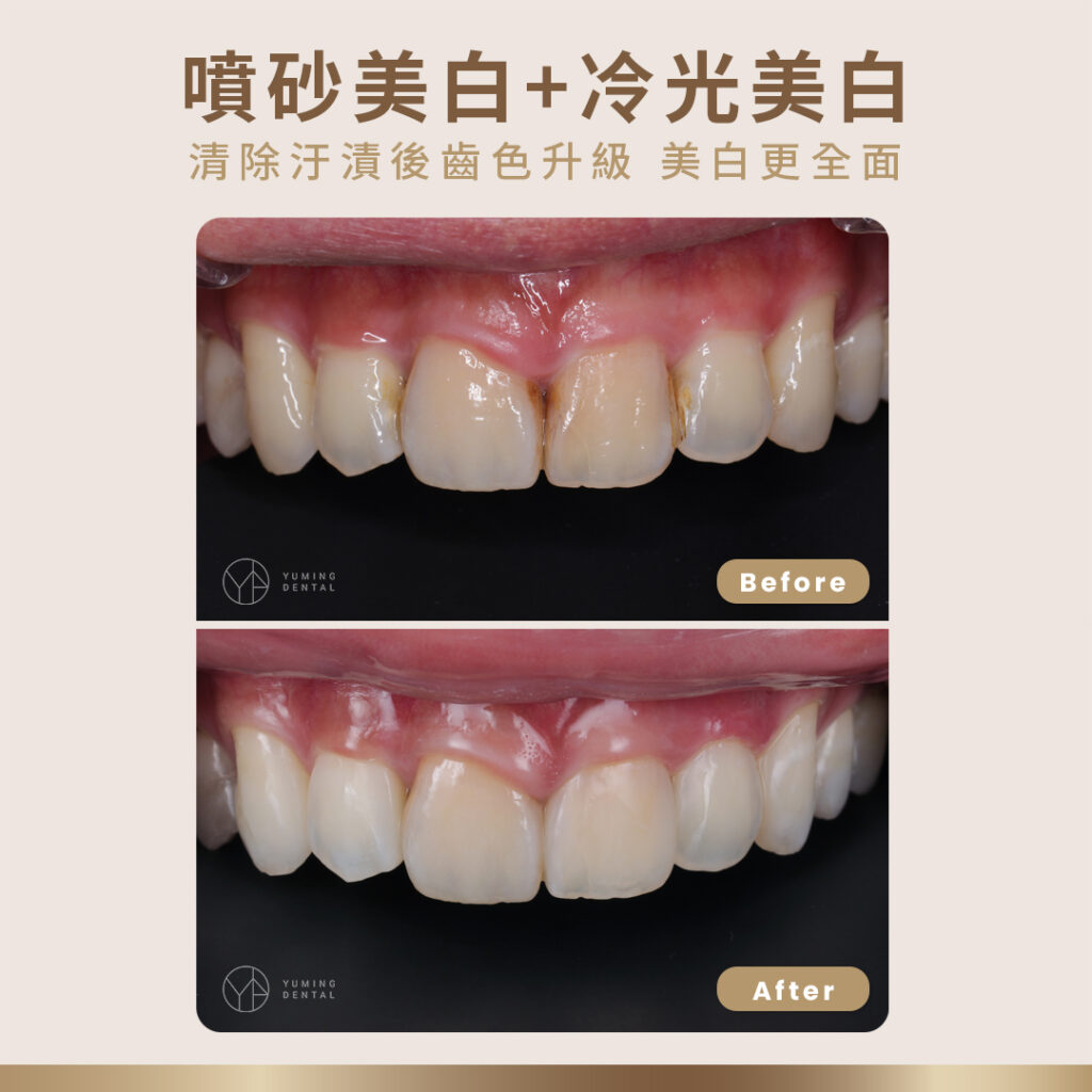 噴砂美白加冷光美白