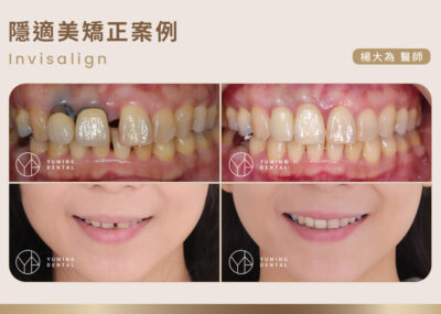 隱適美矯正案例分享｜告別牙縫、深咬與假牙變色困擾！-祐民牙醫 楊大為醫師