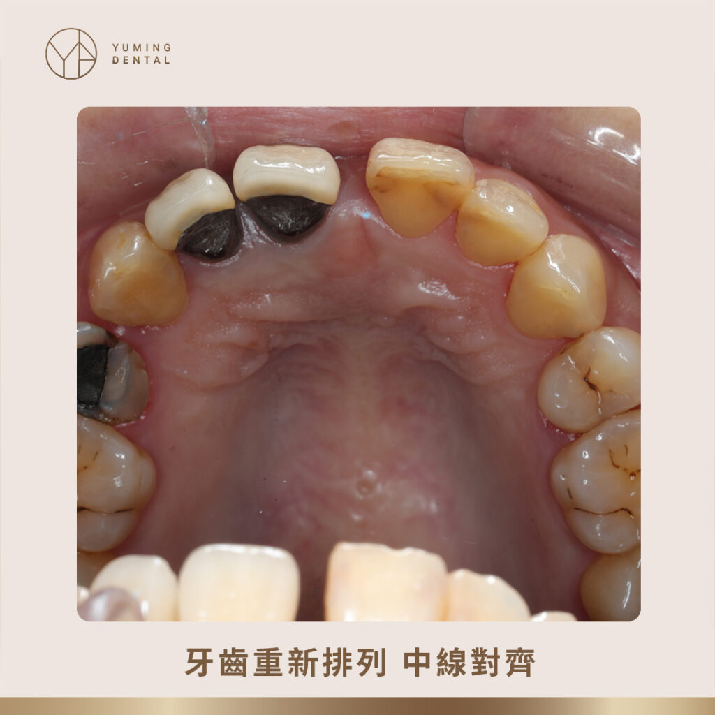 牙齒重新排列，中線對齊（前）