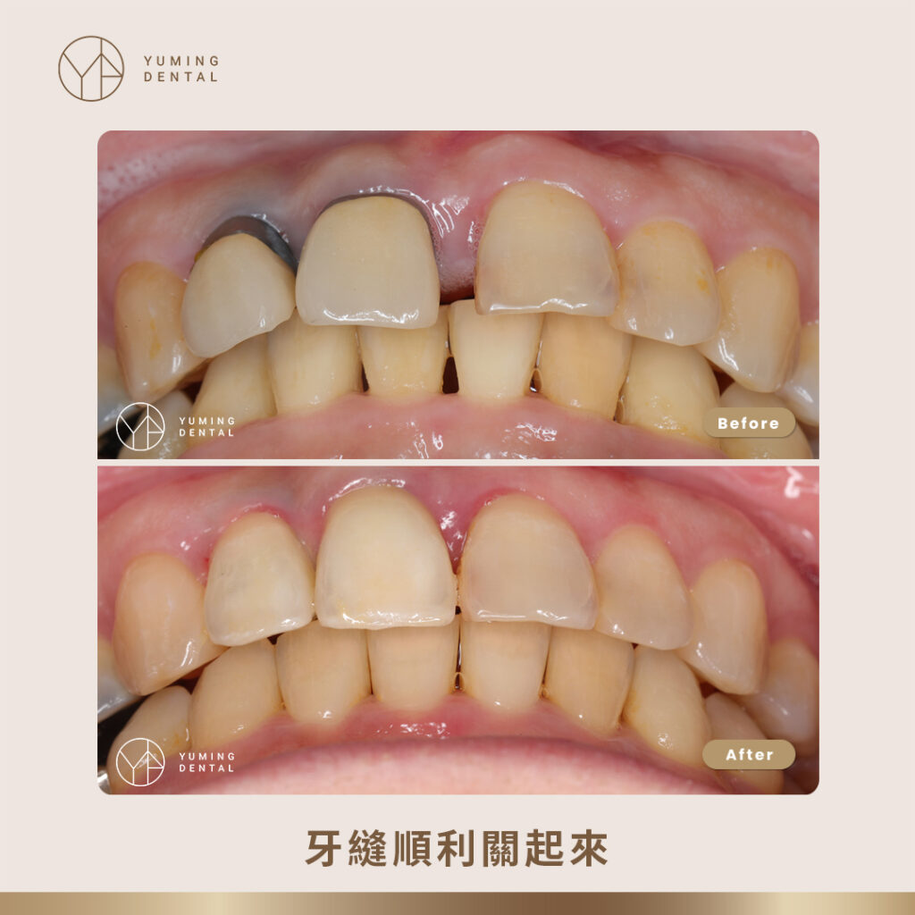 牙縫順利關起來