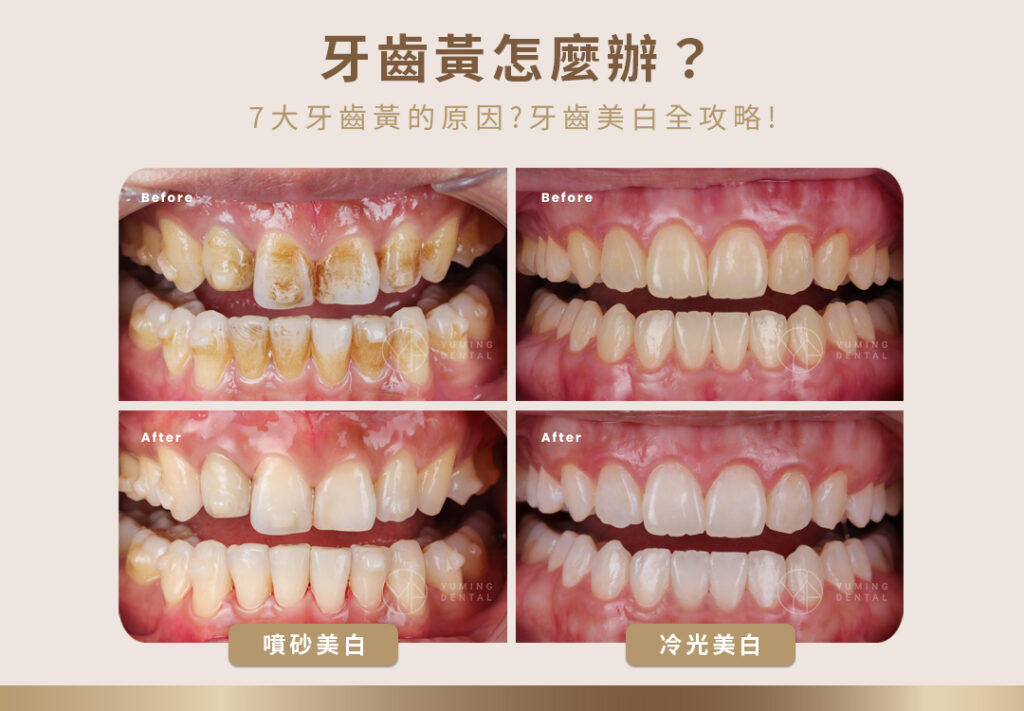 牙齒黃怎麼辦？噴砂美白或冷光美白