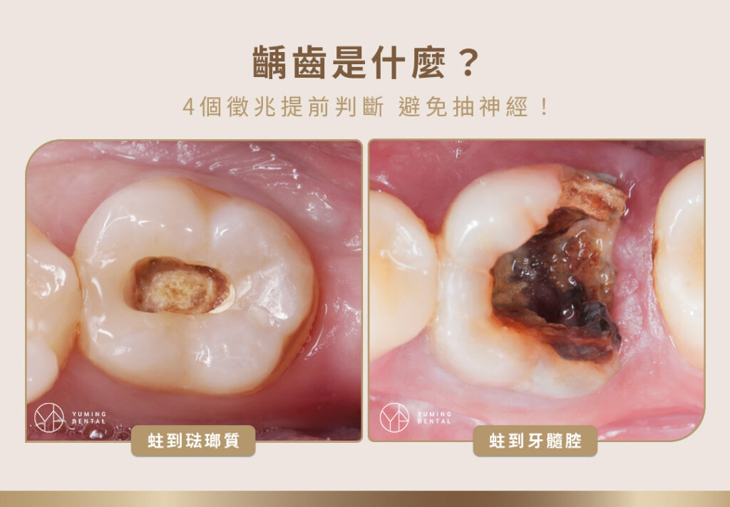 齲齒是什麼？4 個徵兆提前判斷，避免抽神經！