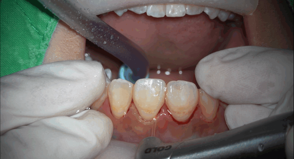 水雷射是什麼？牙周病首選！10 大應用療程與費用