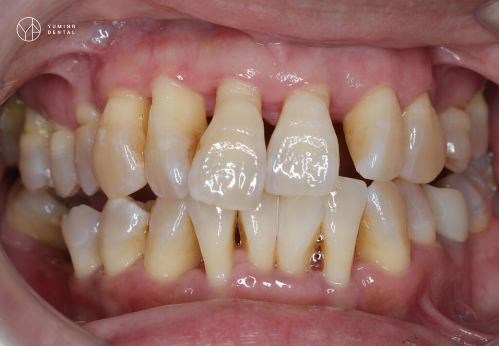 牙齦萎縮口腔圖